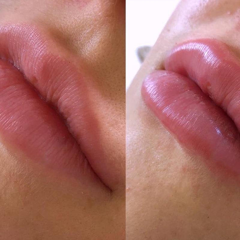 Escultura Labial - Proporção e Naturalidade