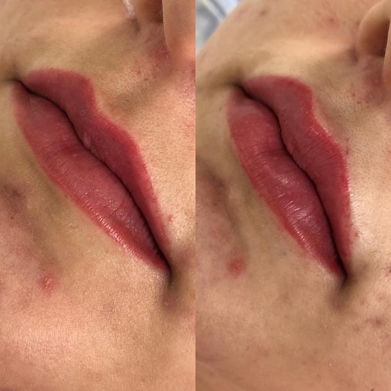 Preenchimento Labial - Contorno e Volume