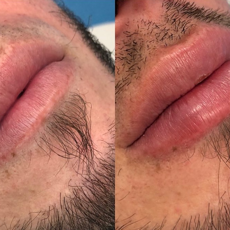 Harmonização Labial Anatômica