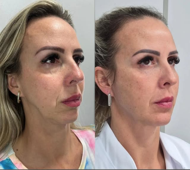 Bioestimuladores de Colágeno & Firmeza